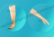 Pusat Pembuatan Tangan Palsu dan Kaki Palsu di Indonesia Telp : 085394849766 Kaki Palsu Makassar - Tangan Palsu Makassar - Hubungi 085394849766