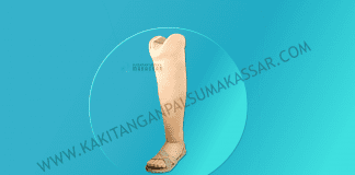 Inilah Cara Memilih Jenis Kaki Palsu Sesuai Lokasi Amputasinya Kaki Palsu Makassar - Tangan Palsu Makassar - Hubungi 085394849766