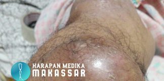 PENANGANAN PEMBUATAN KAKI PALSU PADA AMPUTASI KAKI AKIBAT TUMOR ATAU KANKER TULANG
