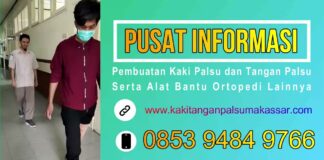 TAHAPAN LATIHAN BERJALAN MENGGUNAKAN KAKI PALSU ATAS DAN KAKI PALSU BAWAH LUTUT Harga Kaki Palsu