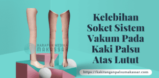 Soket Kaki Palsu Atas Lutut Model Vakum: Keunggulan & Cara Pembuatan KELEBIHAN SOKET SISTEM VAKUM PADA KAKI PALSU ATAS LUTUT