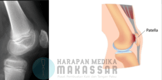 Sakit dan ngilu di persendian lutut saat memakai kaki palsu ? siapa takut !!! Sakit dan ngilu di persendian lutut saat memakai kaki palsu
