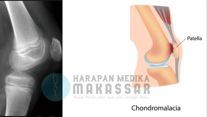 Sakit dan ngilu di persendian lutut saat memakai kaki palsu