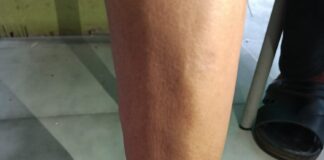 Apakah kaki yang telah di amputasi pada pergelangan kaki bisa di injakkan ? kaki palsu syme prosthesis