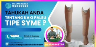 Tahukah Anda tentang Kaki Palsu Tipe Syme? Pembesaran soket kaki palsu: Ilustrasi bagian bawah soket kaki palsu Syme yang menjadi fokus estetika
