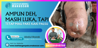 Pentingnya penyembuhan luka sebelum penggunaan prostesis untuk mengatasi masalah amputasi Artikel ini membahas pentingnya kesembuhan luka bekas amputasi sebelum mempertimbangkan penggunaan kaki palsu. Kami menjelaskan peran teknisi kaki palsu, tantangan dalam pemulihan, dan cara menghadapinya. Artikel ini juga memberikan informasi mengenai layanan kaki palsu di Makassar dan alat bantu ortopedi lainnya