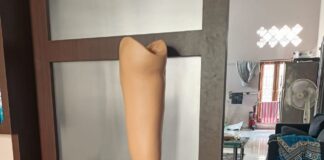 Ternyata Harapan Itu Masih Ada ! Transformasi Seorang Pasien Cacat Lahir Menjadi Pengguna Kaki Palsu yang Mandiri Proses Pembuatan Kaki Palsu