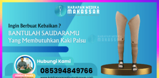 Ingin Berbuat Kebaikan ? Bantulah Saudaramu Yang Membutuhkan Kaki Palsu
