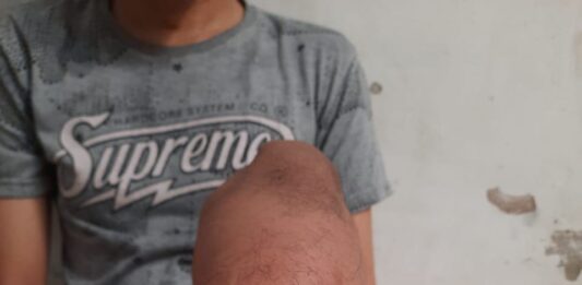 Pelajari penyebab lecet setelah menggunakan kaki palsu dan cari tahu bagaimana cara penanganannya dengan tepat